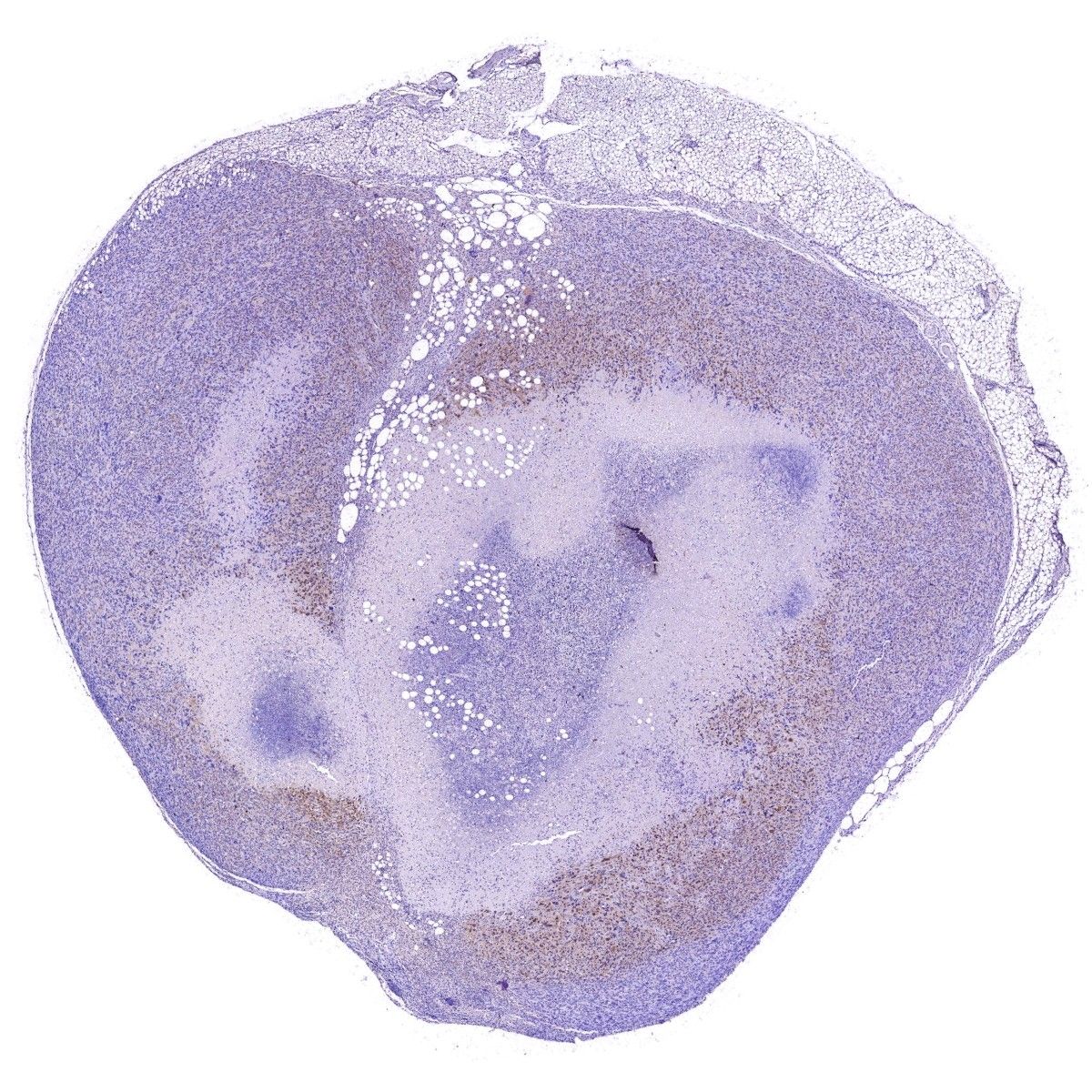 腫瘤組織免疫組化